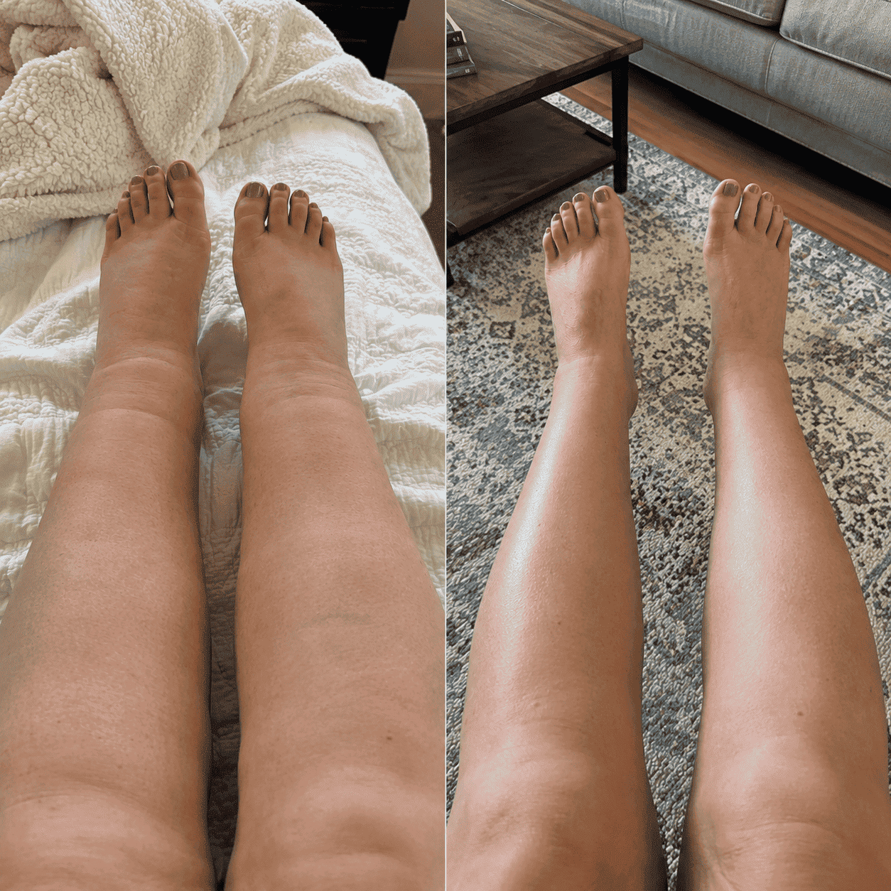 Before and after comparison of swollen legs